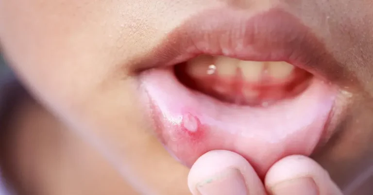 Image related to Canker Sore Treatment For Kids: How Parents Can Comfort Their Kids in Pain